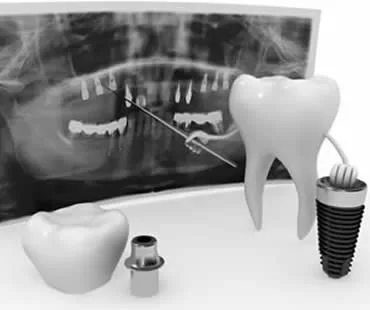 implants