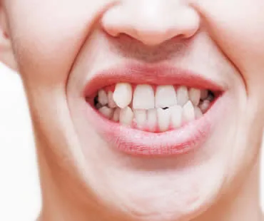 Crooked Teeth Call for a Smile Makeover