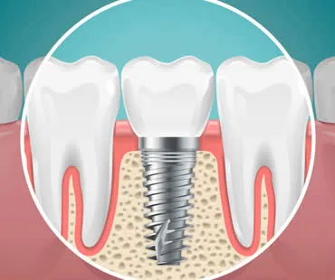 Single Tooth Dental Implant