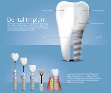 Understanding Dental Implants