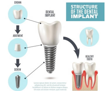 How Dental Implants Changed Dentures Forever