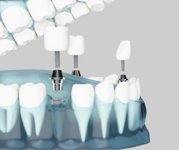 Dental Implants: Choosing the Best Implant Dentist in Conyers