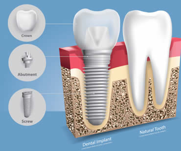 A Thorough Look at Dental Implants