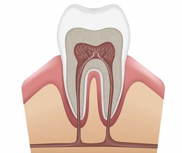 Factors that Affect Your Root Canal Recovery