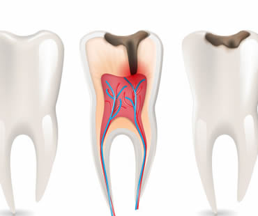 Root Canal Treatment: The Truth